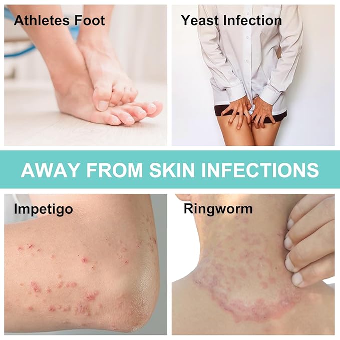 Antifungal Body Wipes, 30 Counts(6 Packs of 5) Travel Wipes, Non-Toxic Skin Camp Wipes Help Athletes Foot, Jock Itch, Ringworm. Rinse Free Gym Wipes for Wrestling, Martial Arts